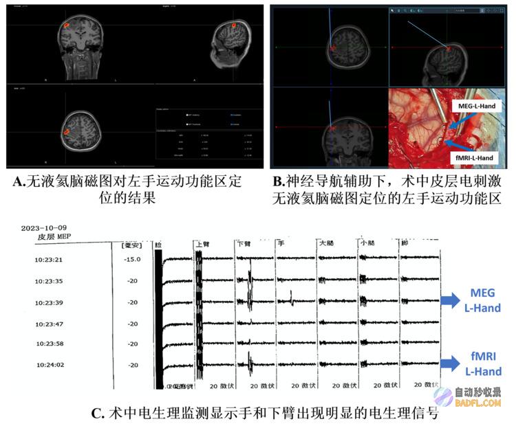 全球首例无液氦脑磁图辅助下的胶质瘤切除手术顺利完成