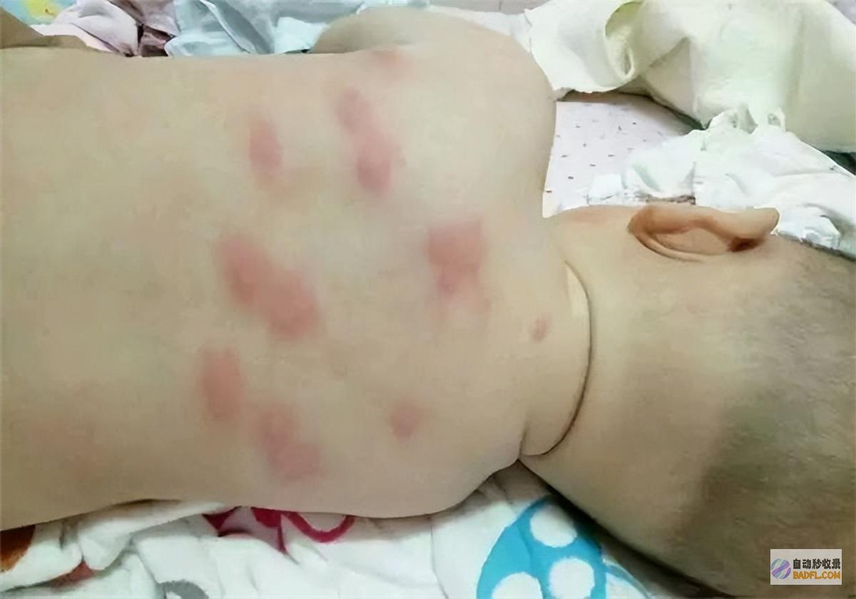 警觉那些咬人的毒虫隐形刺客出没最后一种的毒液
