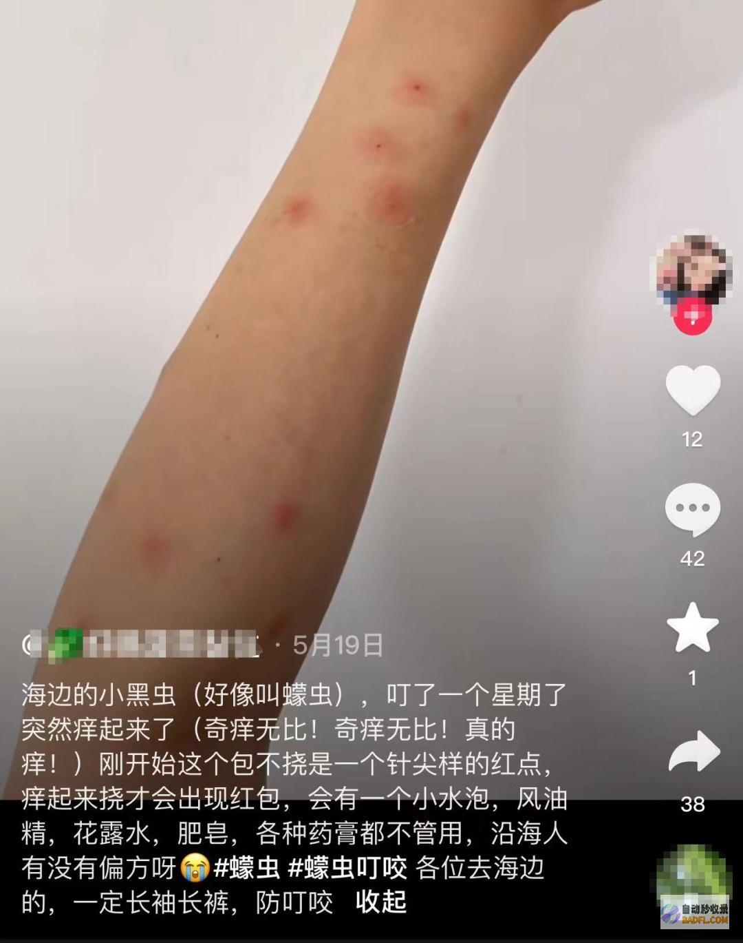 已到高发期也有人中招不少人晒出照片痒到解
