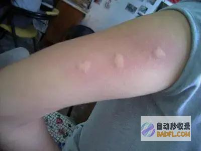 一群人里为啥偏偏就咬你?与血型有关真正的