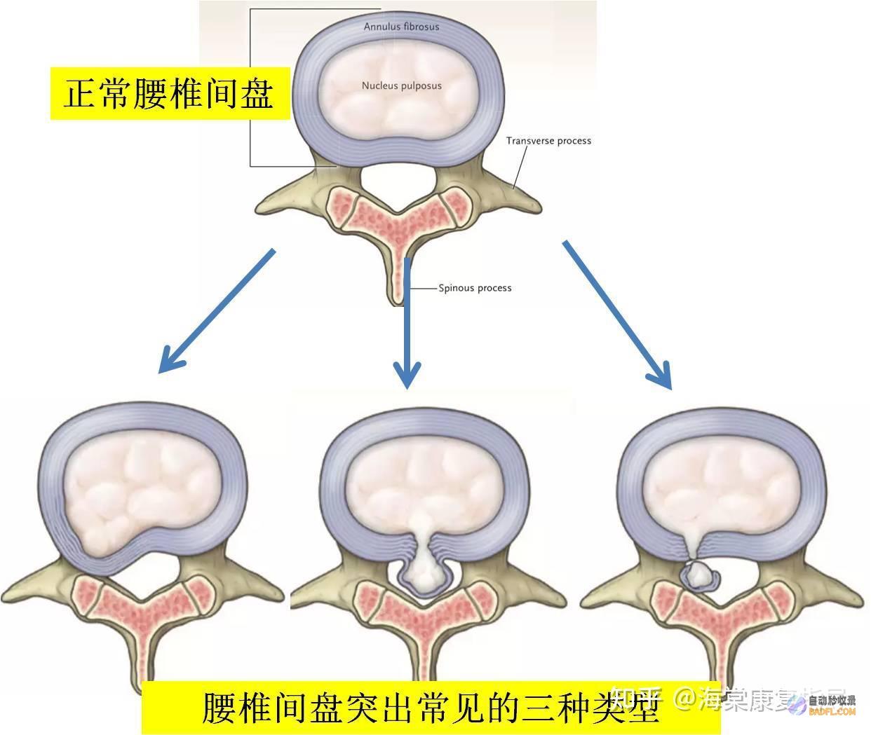 腰椎间盘突出腿麻如何缓解 (腰椎间盘突出最好的治疗方法)