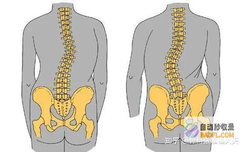 男性脊柱侧弯高达91° 手术治疗后竟增高10cm (男性脊柱侧弯能结婚吗)