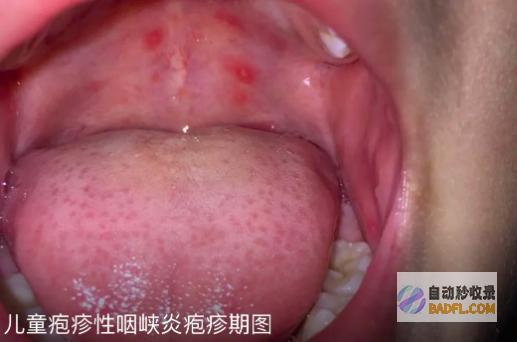 警觉398°C高烧不退多地发现感化病例警觉的拼音