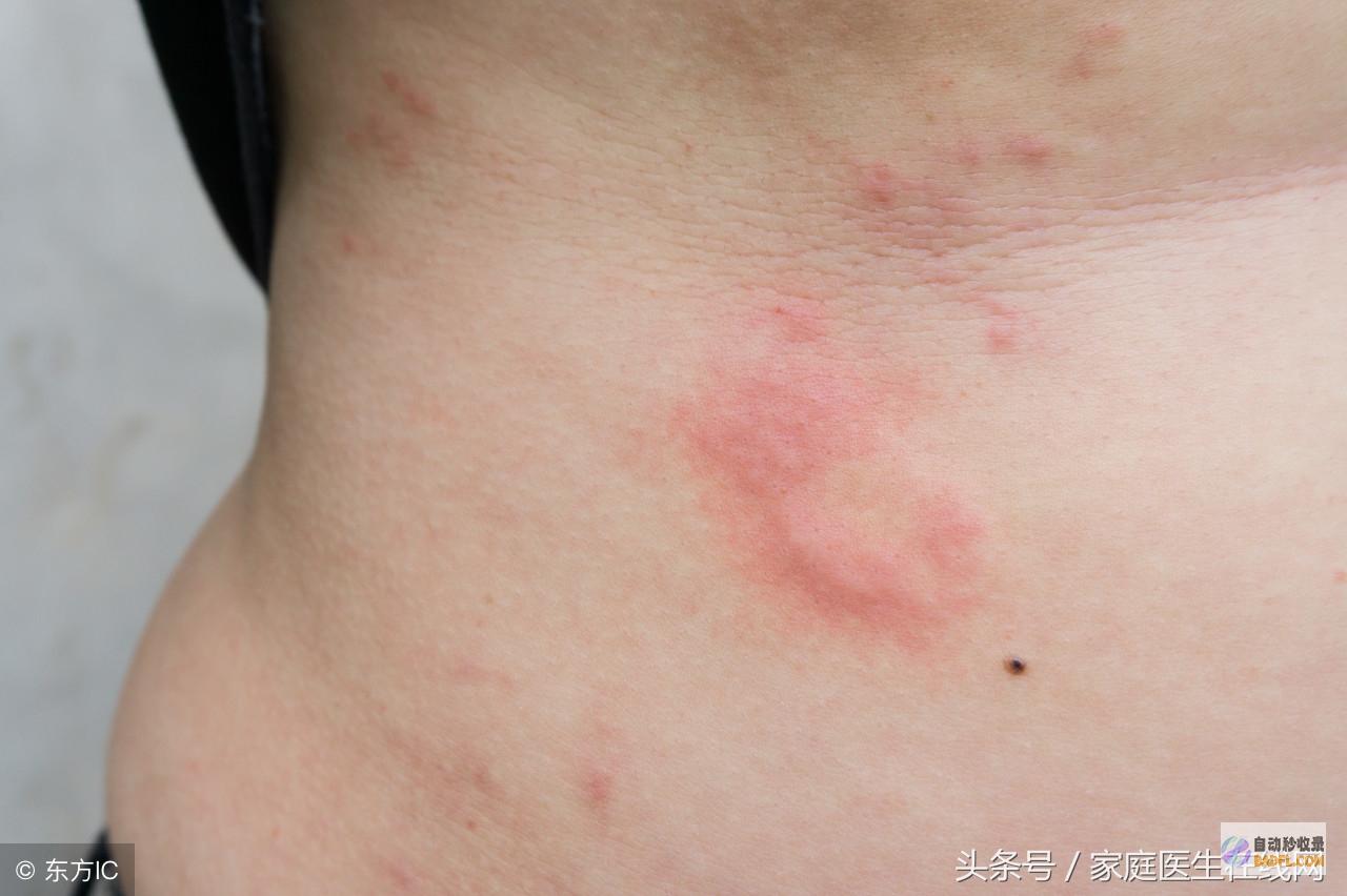 荨麻疹居家治疗指南：7种有效偏方，彻底告别瘙痒红疹 (荨麻疹居家治疗方案)