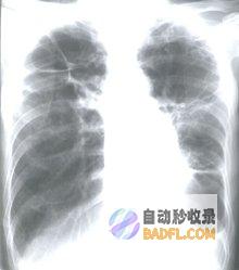 帮助您摆脱呼吸道刺激