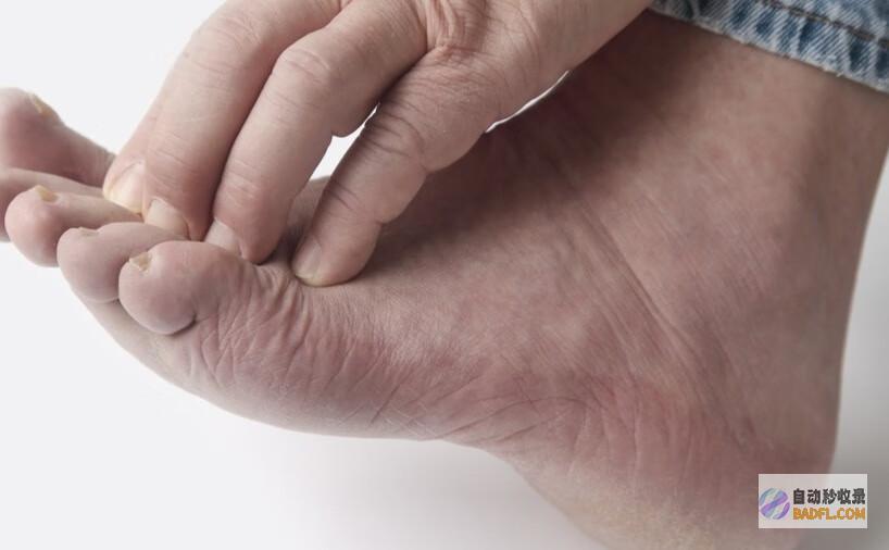 解决冻疮的方法