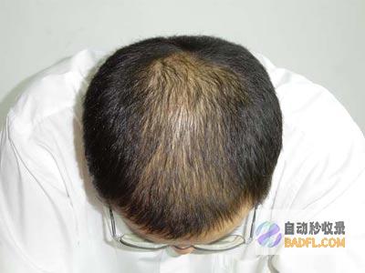 预防脱发：均衡营养，充足睡眠，可以帮助预防脱发。按摩头皮或使用生发液也有助于促进头发生长。(预防脱发的食物有哪些)