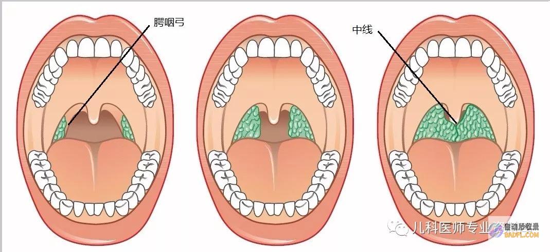 告别扁桃体炎之苦：探索有效的天然偏方宝典 (扁桃体炎怎么消除根)
