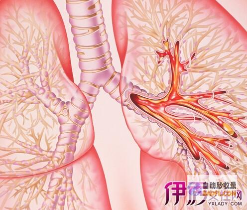 治疗支气管炎的天然疗法： 15 个简单的偏方，可立即缓解 (治疗支气管炎咳嗽的特效药有哪些)