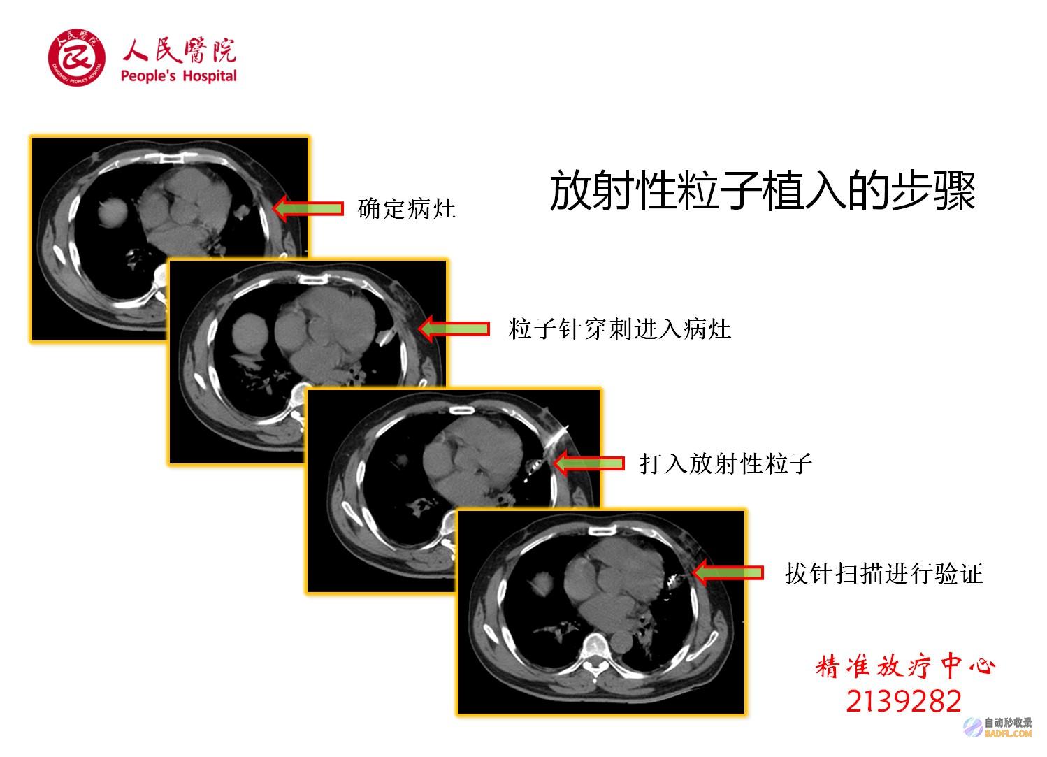 肝癌克星:探索传统民间偏方与前沿医学的协同疗法 (肝癌克星是什么)
