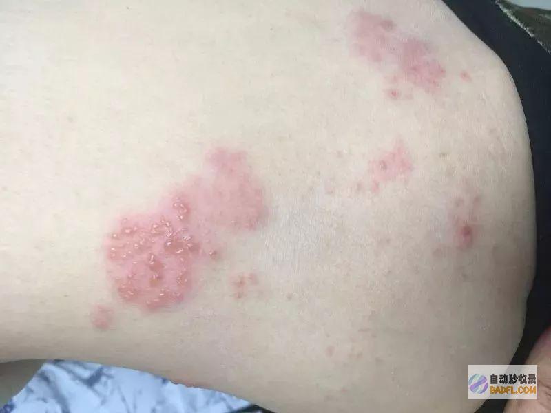 揭秘带状疱疹的秘密疗方：天然偏方缓解疼痛和加速愈合 (揭秘带状疱疹:为何老年人病情更严重? 精选笔记)